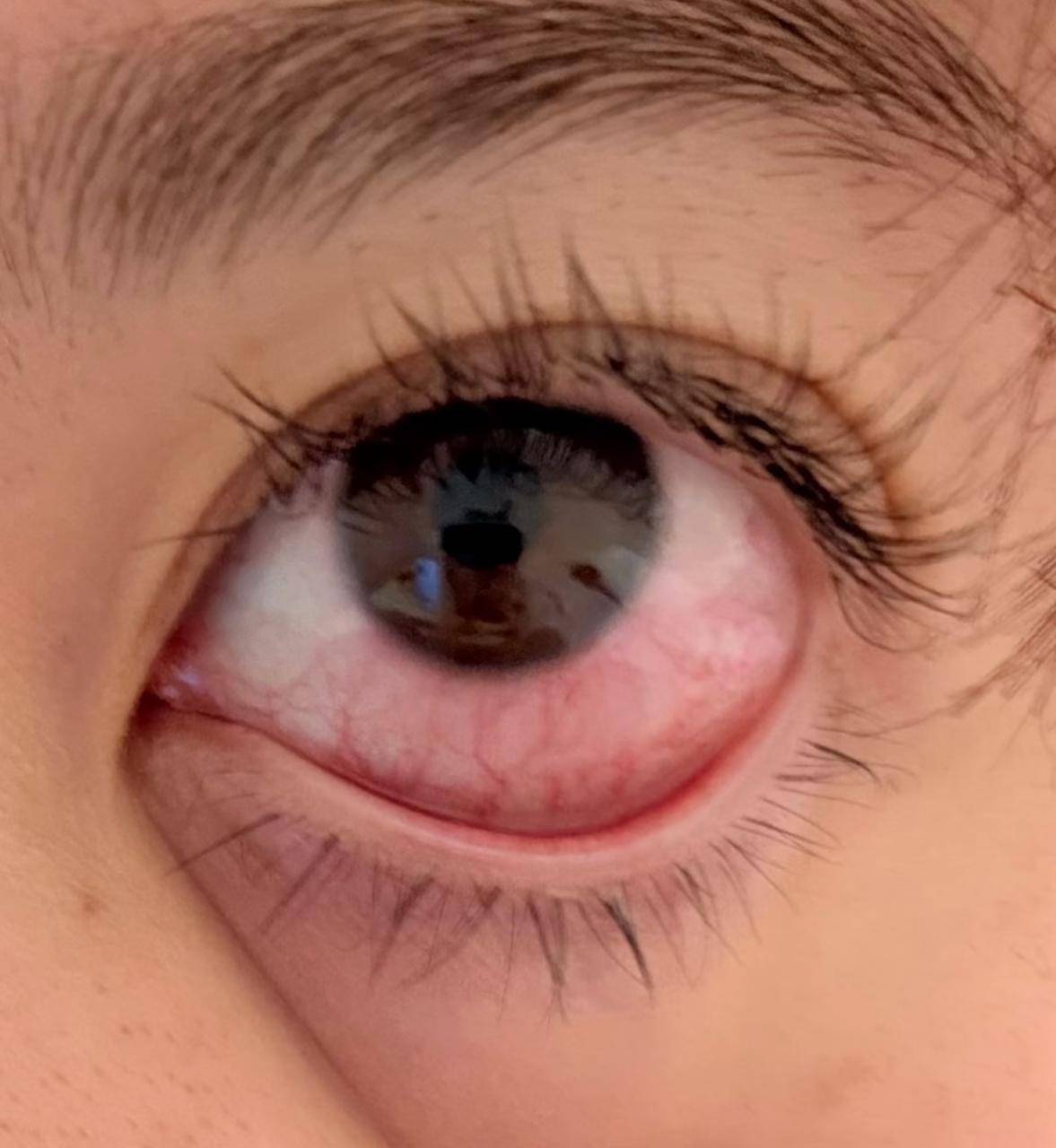 美睫需謹慎！網友嫁接睫毛后角膜上皮受損，醫生提醒愛美女性們避開這些坑